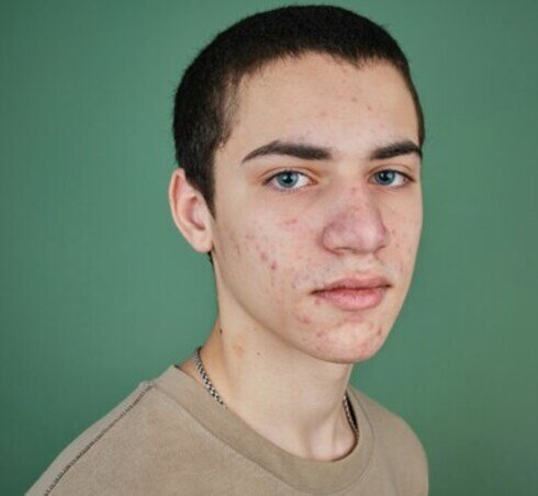 Herpes