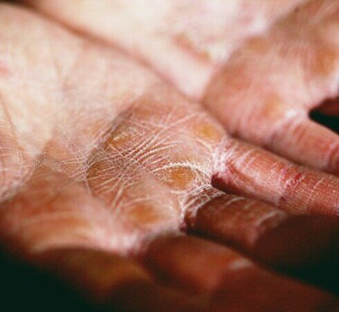 Eczema