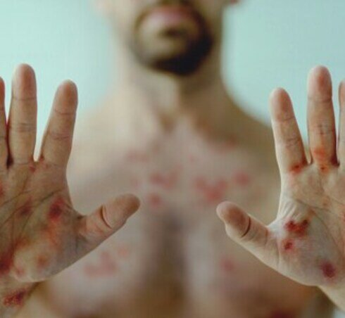 Scabies